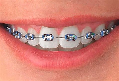 brackets metalicos sin gomas|ortodoncia y brackets.